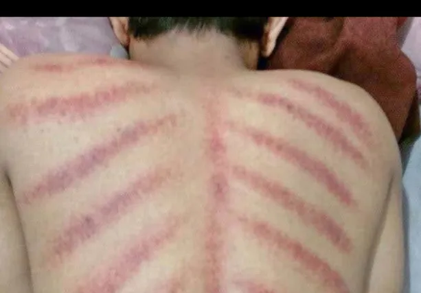 Massage Kerokan untuk Masuk Angin